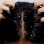 get rid of dandruff